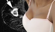 免疫哨卡抑制剂继续扩大适应症,在三阴性乳腺癌显示疗效 免疫哨卡抑制剂继续扩大适应症,在三阴性乳腺癌显示疗效