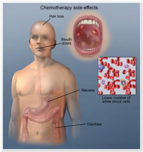 chemotherapy-side-effects-mesothelioma-chemotherapy