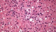 水涨船高：辉瑞、诺华联手进入NASH